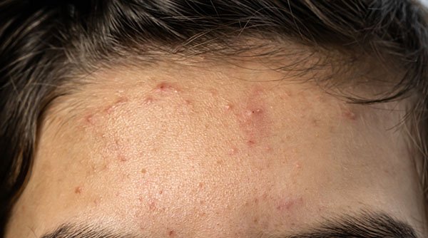 7 Forehead Pimple Causes That You Probably Didn't Know – Garnier India